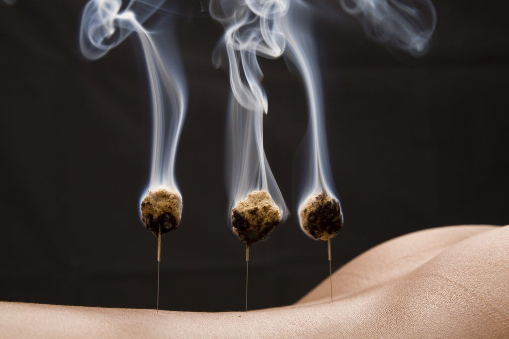 Boles de moxa enceses sobre agulles d'acupuntura a l'esquena