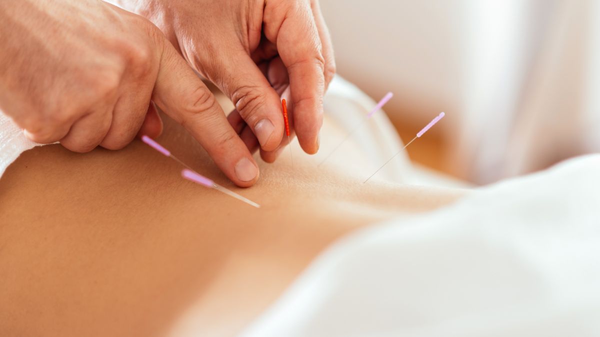 acupuntura