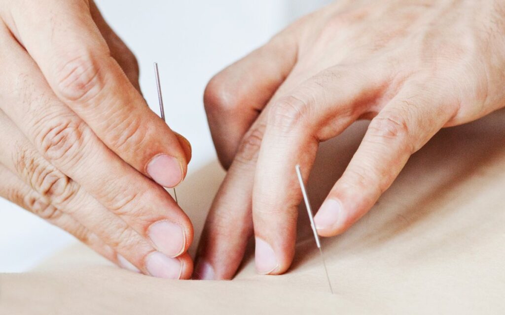 acupuntura