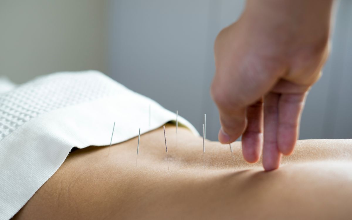 acupuntura