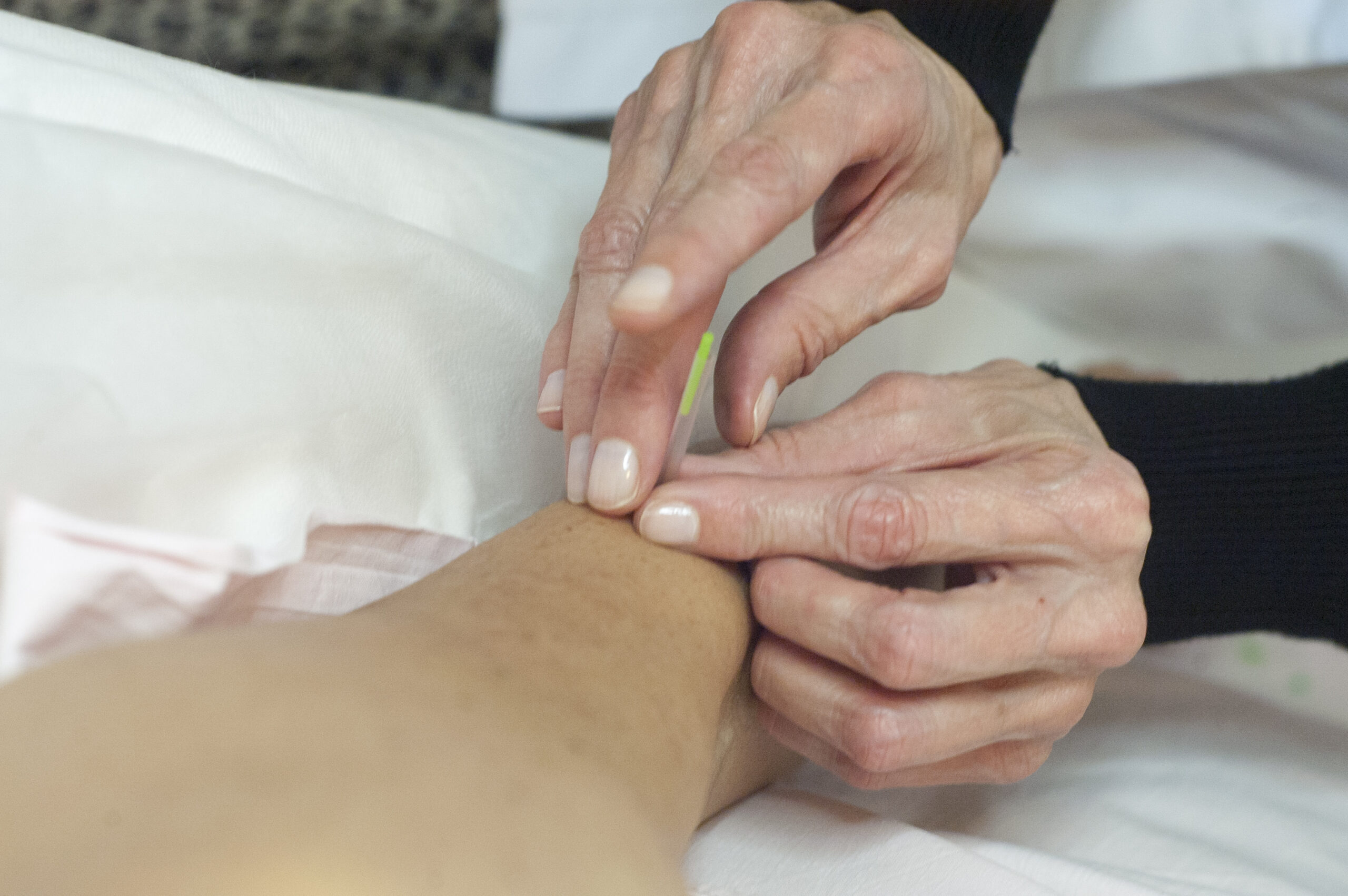 Aplicación de una aguja de acupuntura con tubo guía