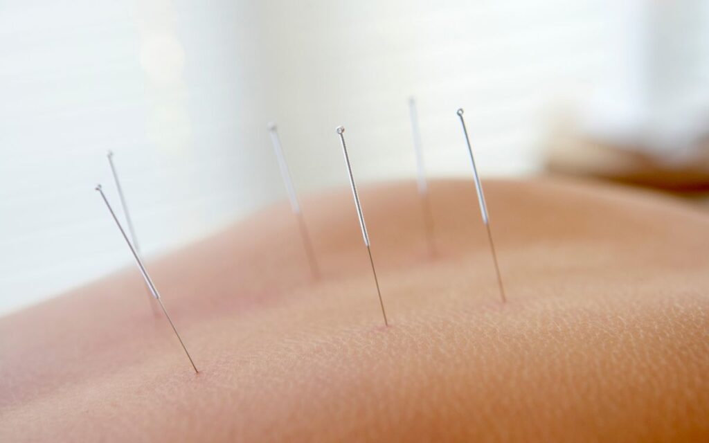 acupuntura comunitaria