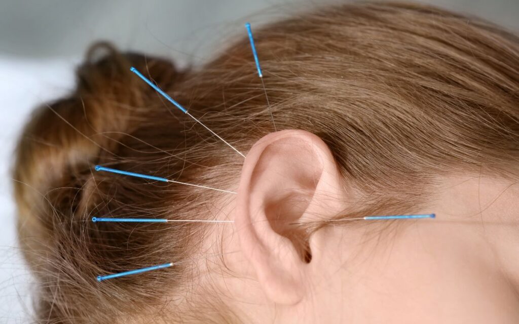 acupuntura comunitaria